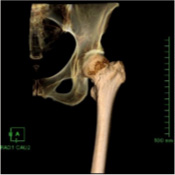 放射線科_6_CTの主な検査骨病変_03